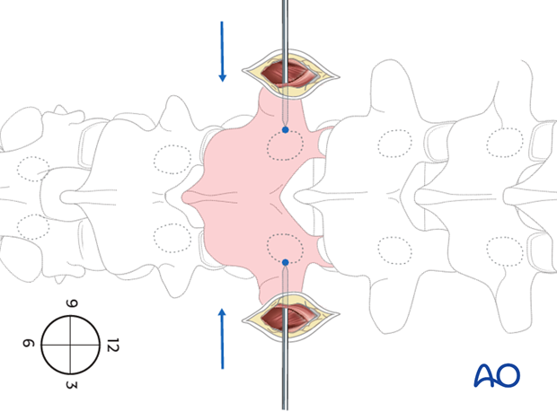 percutaneous posterior approach for pedicle screw placement