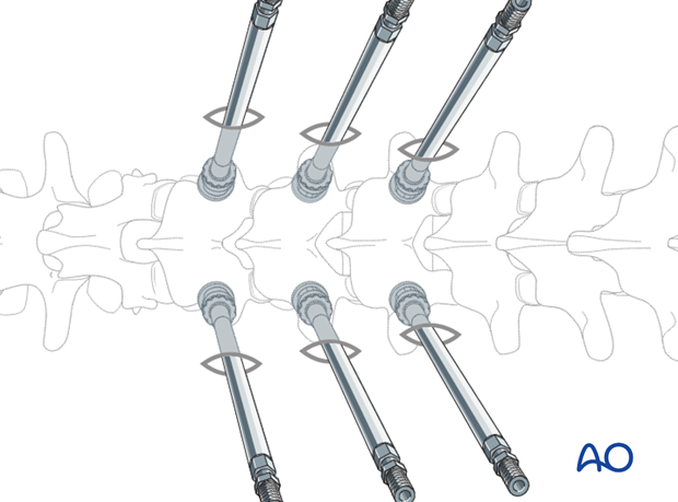 percutaneous posterior approach for pedicle screw placement