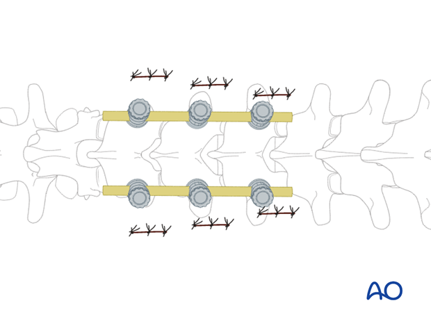 percutaneous posterior approach for pedicle screw placement