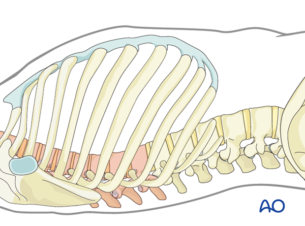 Thoracic and lumbar fractures: Minimally invasive right sided thoracic approach (T4-T10)