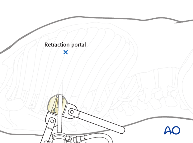 Thoracic and lumbar fractures: Minimally invasive right sided thoracic approach (T4-T10)