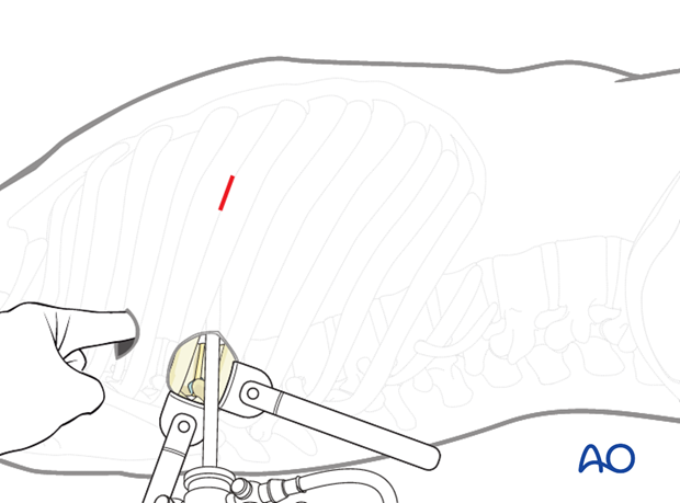 Thoracic and lumbar fractures: Minimally invasive right sided thoracic approach (T4-T10)