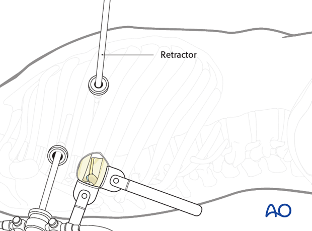 Thoracic and lumbar fractures: Minimally invasive right sided thoracic approach (T4-T10)