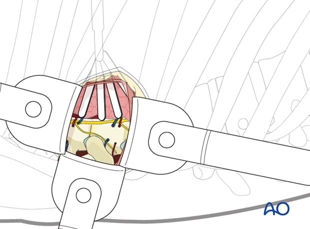 Thoracic and lumbar fractures: Minimally invasive right sided thoracic approach (T4-T10)