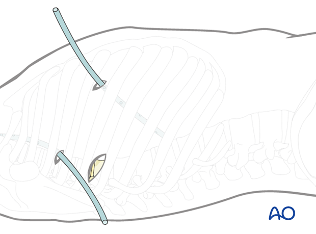 Thoracic and lumbar fractures: Minimally invasive right sided thoracic approach (T4-T10)