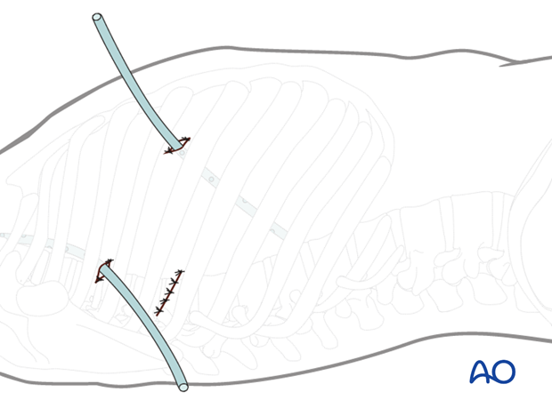 Thoracic and lumbar fractures: Minimally invasive right sided thoracic approach (T4-T10)