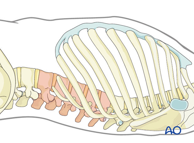 Thoracic and lumbar fractures: Minimally invasive left sided thoracic approach (T10-L2)