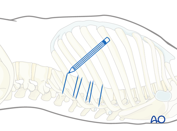 Thoracic and lumbar fractures: Minimally invasive left sided thoracic approach (T10-L2)