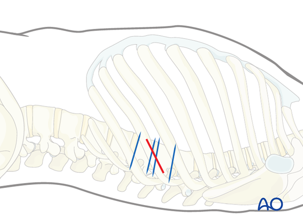 Thoracic and lumbar fractures: Minimally invasive left sided thoracic approach (T10-L2)