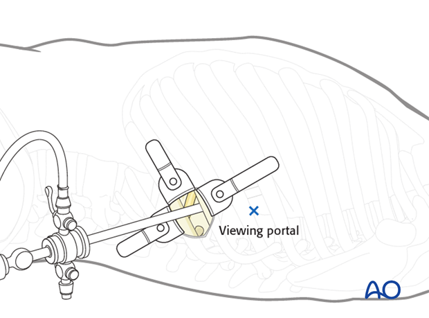 Thoracic and lumbar fractures: Minimally invasive left sided thoracic approach (T10-L2)