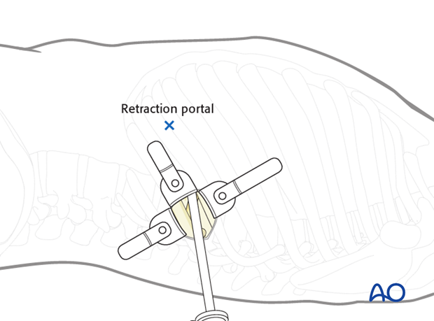 Thoracic and lumbar fractures: Minimally invasive left sided thoracic approach (T10-L2)