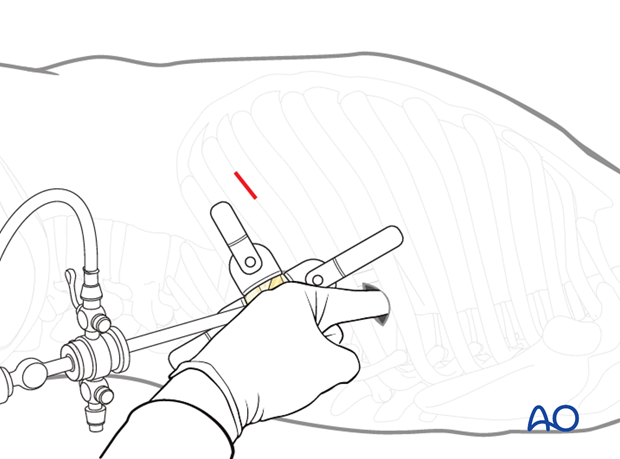 Thoracic and lumbar fractures: Minimally invasive left sided thoracic approach (T10-L2)