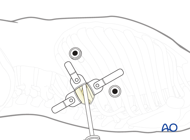 Thoracic and lumbar fractures: Minimally invasive left sided thoracic approach (T10-L2)