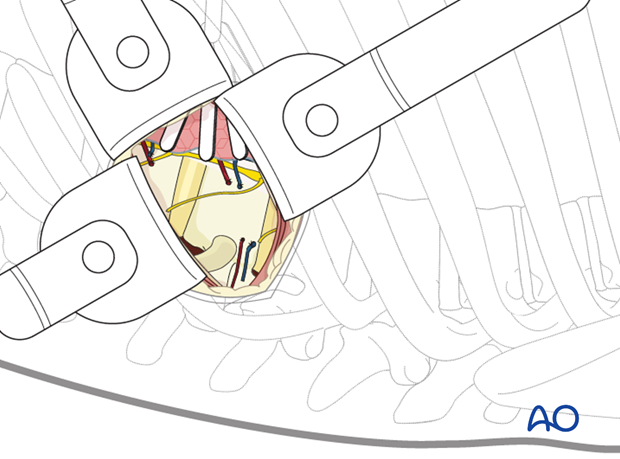 Thoracic and lumbar fractures: Minimally invasive left sided thoracic approach (T10-L2)