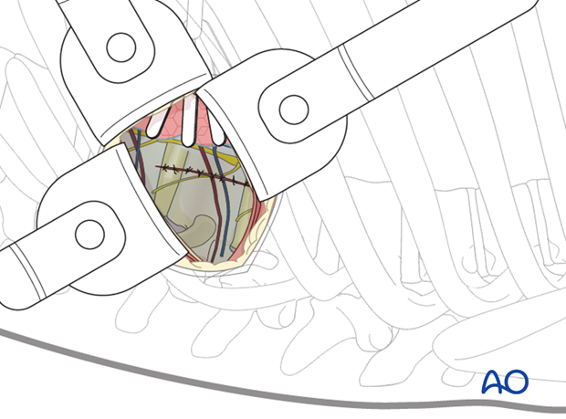 Thoracic and lumbar fractures: Minimally invasive left sided thoracic approach (T10-L2)