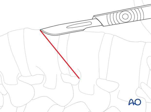 Thoracic and lumbar fractures: Minimally invasive lumbotomy (L2-L4)