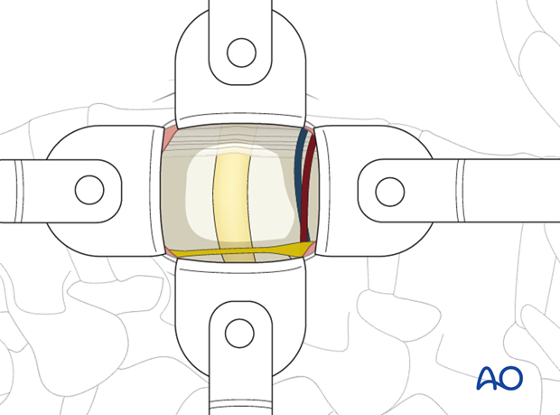 Thoracic and lumbar fractures: Minimally invasive lumbotomy (L2-L4)