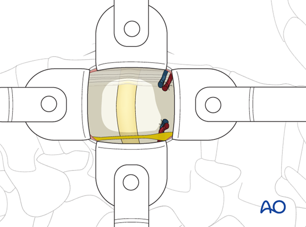 Thoracic and lumbar fractures: Minimally invasive lumbotomy (L2-L4)