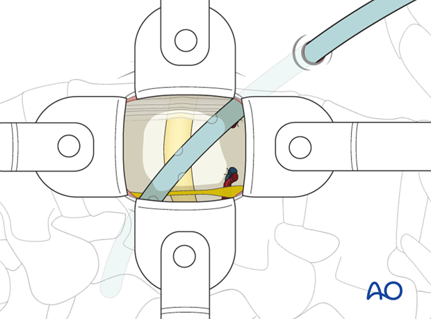 Thoracic and lumbar fractures: Minimally invasive lumbotomy (L2-L4)