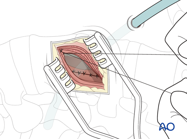 Thoracic and lumbar fractures: Minimally invasive lumbotomy (L2-L4)