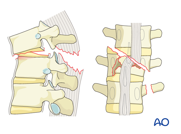 Thoracic and Lumbar Fractures: Rationale for fracture classification