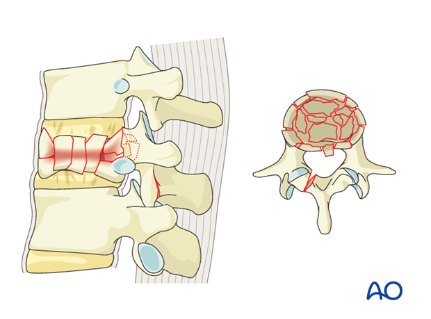 Thoracic and Lumbar Fractures: Rationale for fracture classification