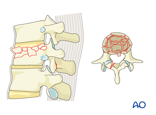 Thoracic and Lumbar Fractures: Rationale for fracture classification