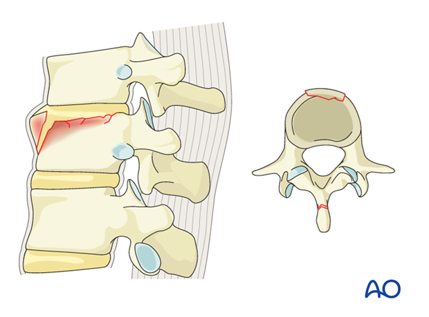 Thoracic and Lumbar Fractures: Rationale for fracture classification