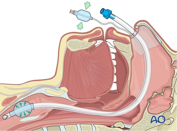 Thoracic and lumbar fractures: Patient examination - clinical evaluation