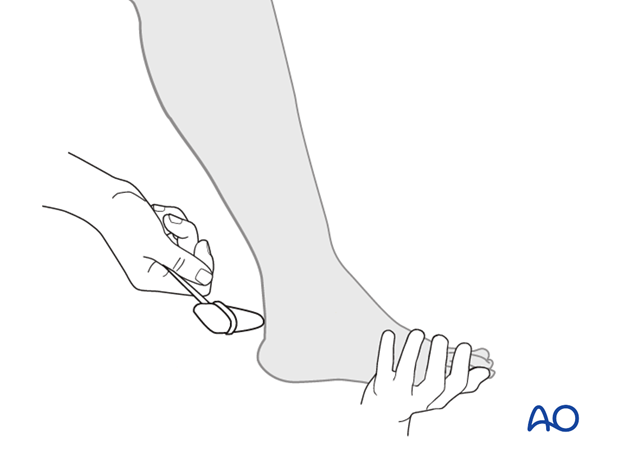 Thoracic and lumbar fractures: Patient examination - neurological evaluation