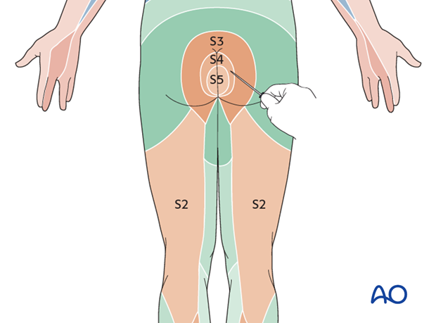 Thoracic and lumbar fractures: Patient examination - neurological evaluation