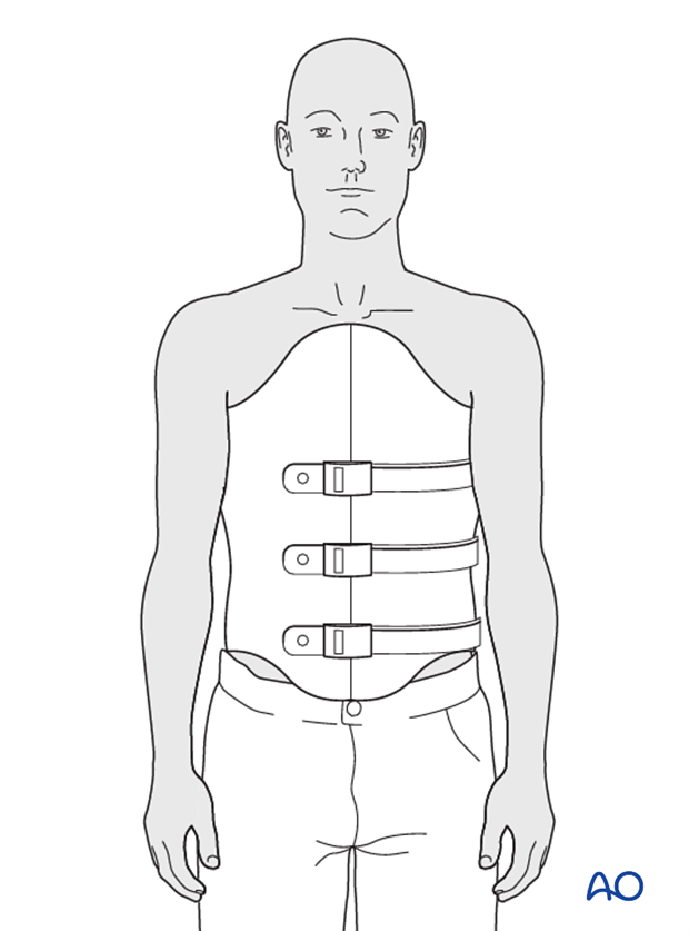 Thoracic and lumbar fractures: Nonoperative treatment - bracing