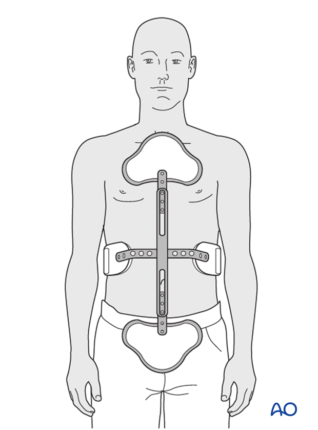 Thoracic and lumbar fractures: Nonoperative treatment - bracing