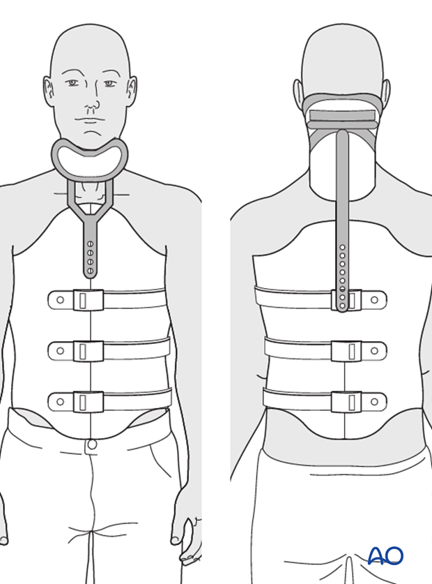 Thoracic and lumbar fractures: Nonoperative treatment - bracing