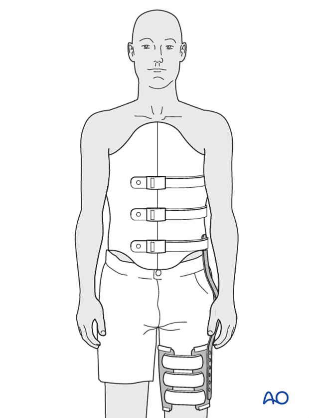 Thoracic and lumbar fractures: Nonoperative treatment - bracing