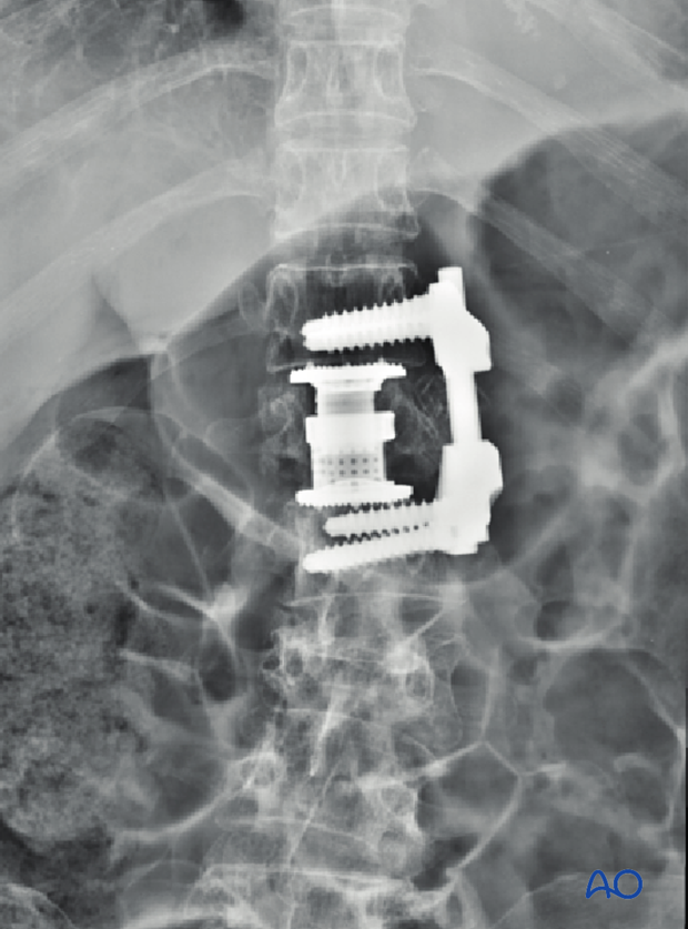 Thoracic and lumbar fractures: Anterior stabilization