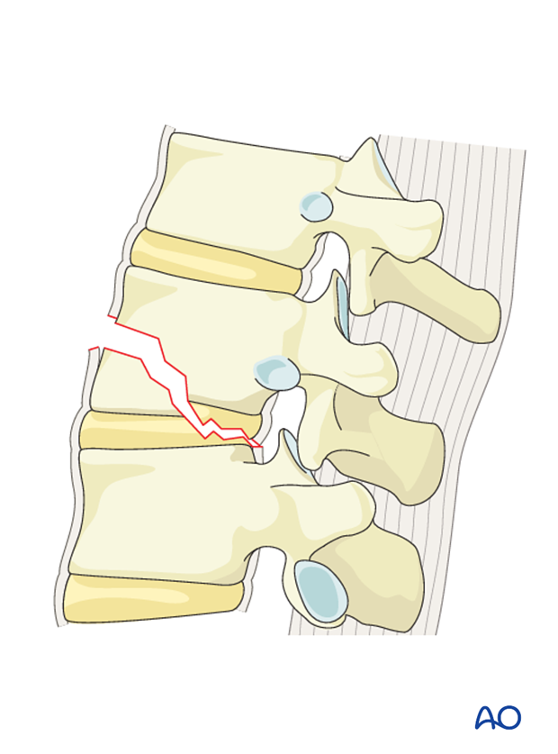 Thoracic and lumbar fractures: Anterior stabilization