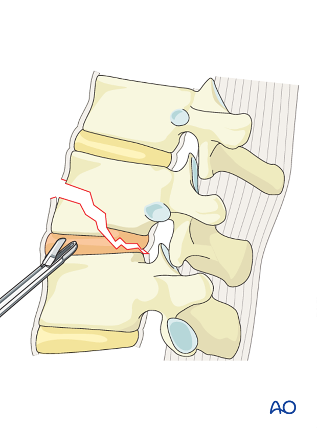 Thoracic and lumbar fractures: Anterior stabilization