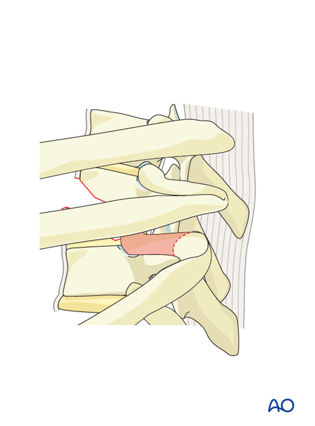 Thoracic and lumbar fractures: Anterior stabilization