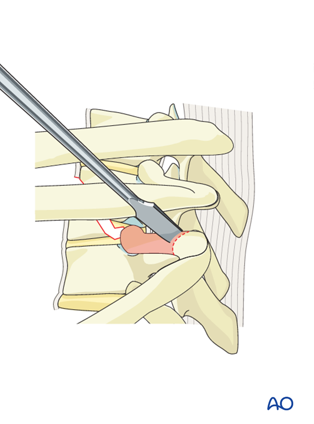 Thoracic and lumbar fractures: Anterior stabilization