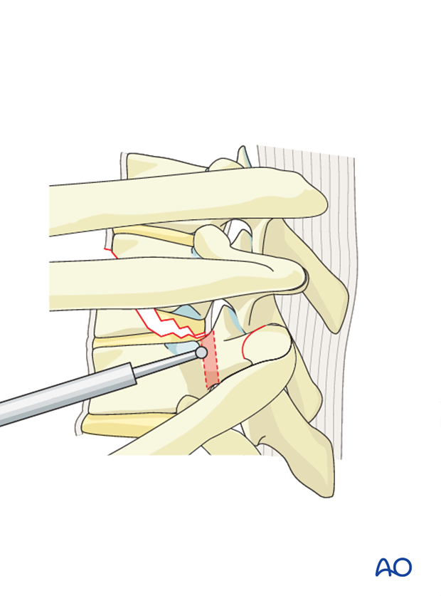 Thoracic and lumbar fractures: Anterior stabilization