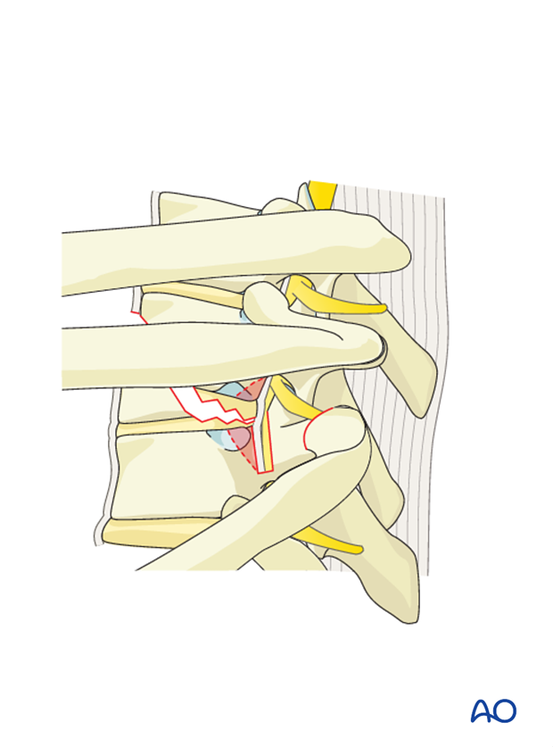 Thoracic and lumbar fractures: Anterior stabilization