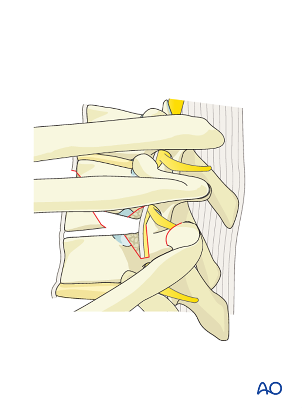 Thoracic and lumbar fractures: Anterior stabilization