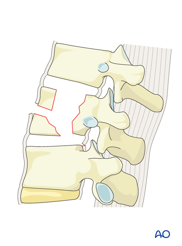 Thoracic and lumbar fractures: Anterior stabilization