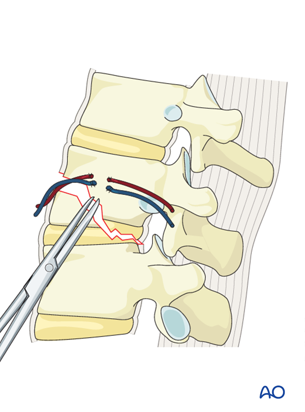 Thoracic and lumbar fractures: Anterior stabilization