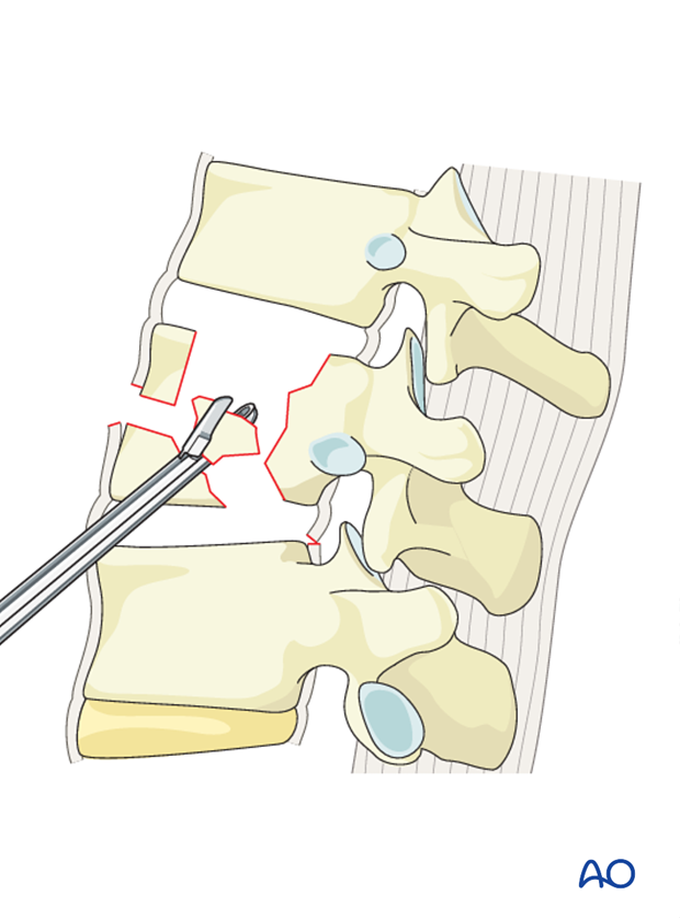 Thoracic and lumbar fractures: Anterior stabilization