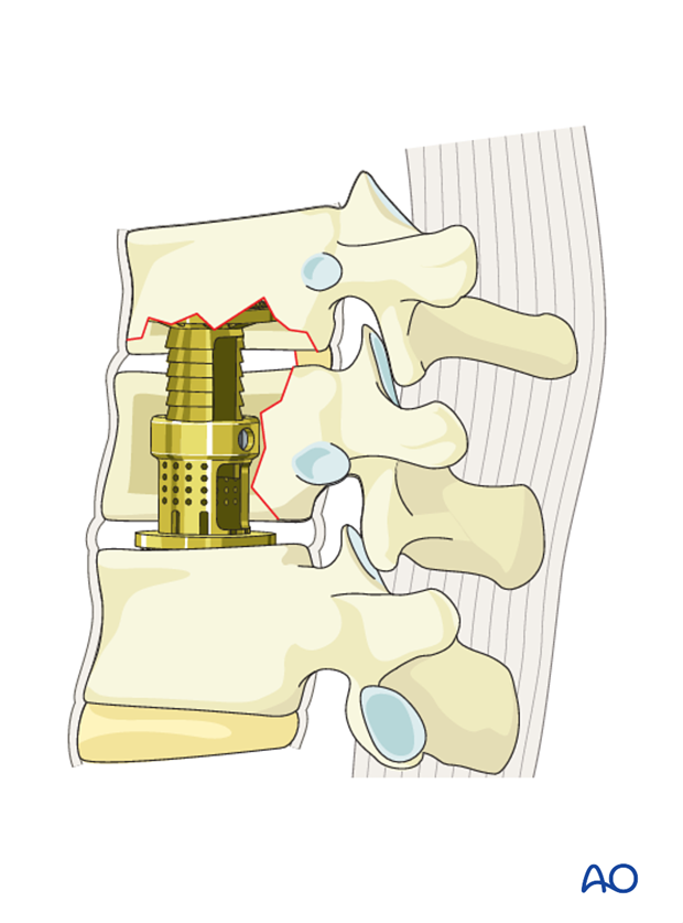 Thoracic and lumbar fractures: Anterior stabilization