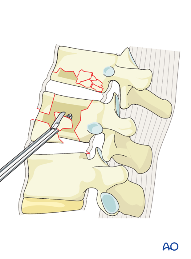 Thoracic and lumbar fractures: Anterior stabilization