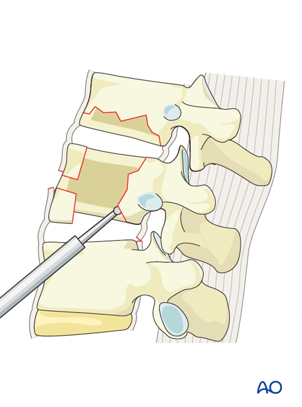 Thoracic and lumbar fractures: Anterior stabilization