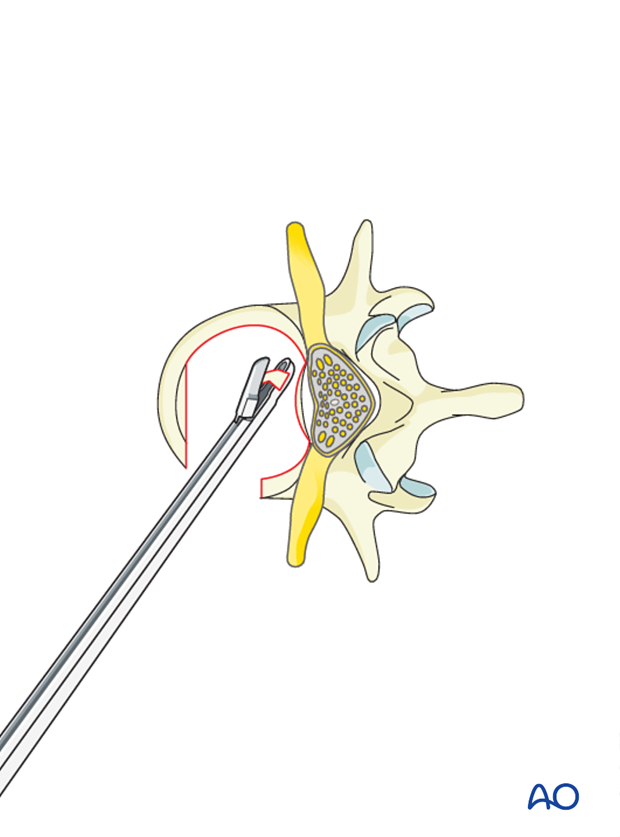 Thoracic and lumbar fractures: Anterior stabilization